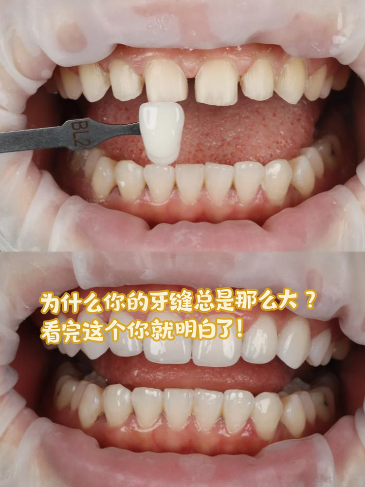 牙齿缝隙大怎么办